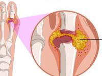 BỆNH GOUT (GÚT): NGUYÊN NHÂN, TRIỆU CHỨNG, CHẨN ĐOÁN VÀ ĐIỀU TRỊ