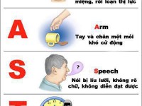 Nhận diện đột quỵ não và xử trí đột quỵ não cấp tại cơ sở