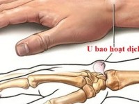 Những điều cần biết về viêm bao hoạt dịch khớp