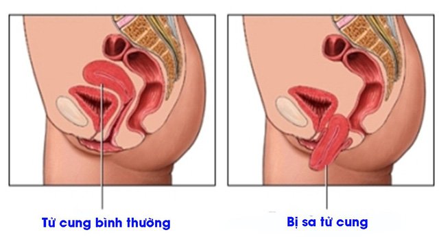 Tiếp nhận, điều trị hiệu quả nhiều ca bệnh sa sinh dục