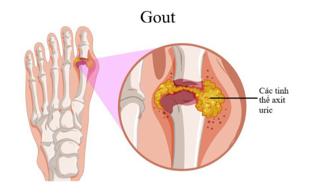 BỆNH GOUT (GÚT): NGUYÊN NHÂN, TRIỆU CHỨNG, CHẨN ĐOÁN VÀ ĐIỀU TRỊ