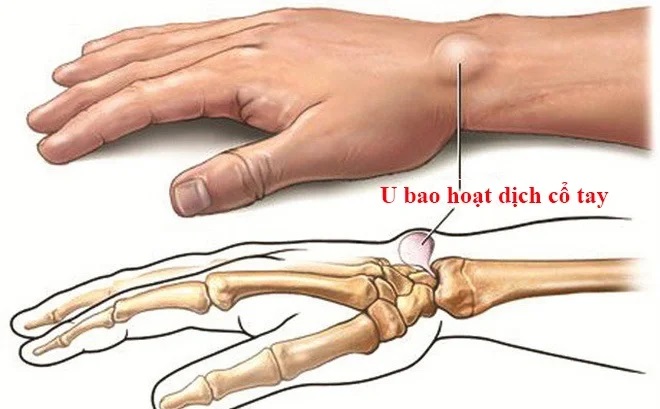 Những điều cần biết về viêm bao hoạt dịch khớp